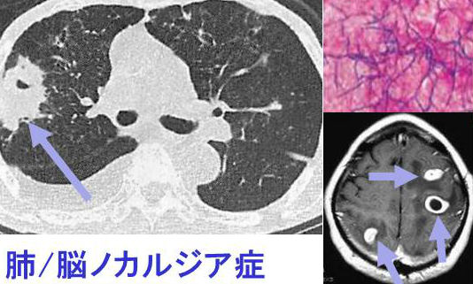肺ノカルジア症/脳ノカルジア症 肺ノカルジア症/脳ノカルジア症