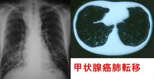 甲状腺癌の肺転移 甲状腺癌の肺転移