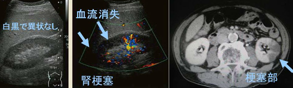 腎梗塞 腎梗塞