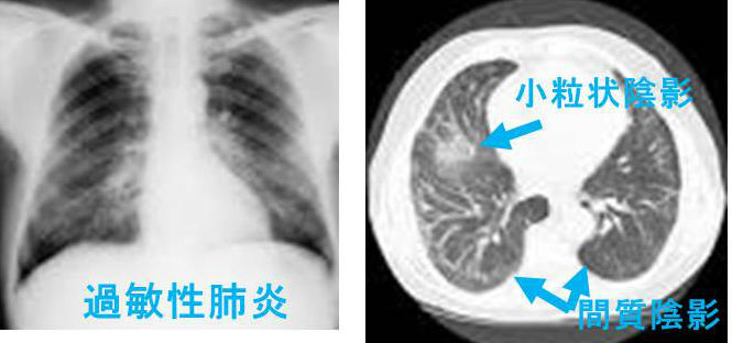 過敏性肺炎 過敏性肺炎