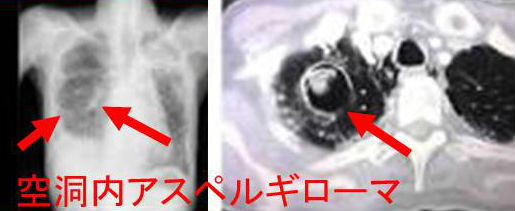 空洞内菌球(アスペルギローマ) 空洞内菌球(アスペルギローマ)