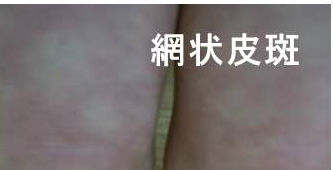 網状皮斑(リベドー:livedo racemosa) 網状皮斑(リベドー:livedo racemosa)