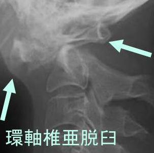 ダウン症候群と甲状腺の病気 ダウン症候群と甲状腺の病気