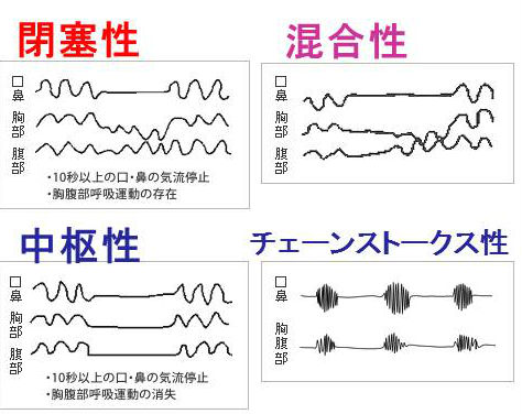 睡眠時無呼吸症候群 睡眠時無呼吸症候群