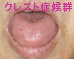 クレスト(CREST)症候群 舌の毛細血管拡張症 クレスト(CREST)症候群 舌の毛細血管拡張症