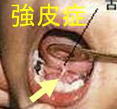 強皮症 舌小帯萎縮 強皮症 舌小帯萎縮