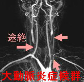 大動脈炎症候群(高安動脈炎、脈なし病) 大動脈炎症候群(高安動脈炎、脈なし病)