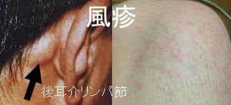 亜急性甲状腺炎と鑑別を要する風疹 亜急性甲状腺炎と鑑別を要する風疹