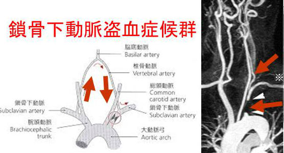 鎖骨下動脈盗血症候群 鎖骨下動脈盗血症候群