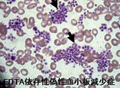 EDTA依存性偽性血小板減少症 EDTA依存性偽性血小板減少症