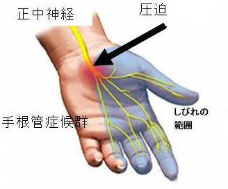 甲状腺機能低下症と手根管症候群 甲状腺機能低下症と手根管症候群