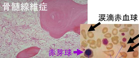 骨髄線維症 骨髄線維症