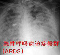 急性呼吸窮迫(こきゅうひっぱく)症候群(ARDS) 急性呼吸窮迫(こきゅうひっぱく)症候群(ARDS)