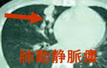 甲状腺癌肺転移で肺動静脈瘻 甲状腺癌肺転移で肺動静脈瘻