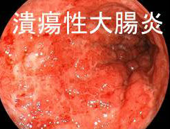 潰瘍性大腸炎 内視鏡写真 潰瘍性大腸炎 内視鏡写真