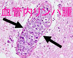 血管内リンパ腫 血管内リンパ腫