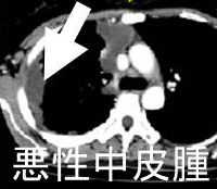 悪性中皮腫 CT画像 悪性中皮腫 CT画像
