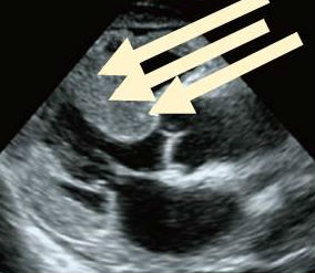 心アミロイドーシス 心アミロイドーシス