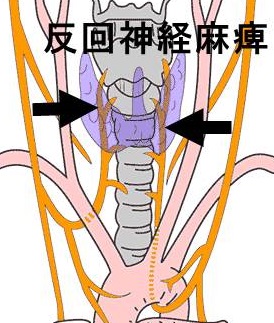 甲状腺の手術合併症、反回神経麻痺 甲状腺の手術合併症、反回神経麻痺