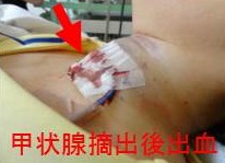 甲状腺摘出後出血 甲状腺摘出後出血
