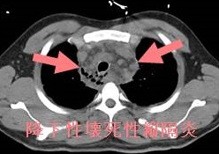 降下性壊死性縦隔炎 CT画像 降下性壊死性縦隔炎 CT画像