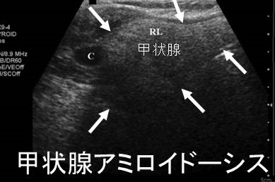 甲状腺アミロイドーシス 超音波(エコー)画像 甲状腺アミロイドーシス 超音波(エコー)画像