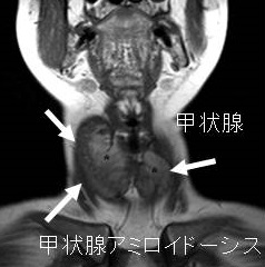 甲状腺アミロイドーシス(MRI) 甲状腺アミロイドーシス(MRI)