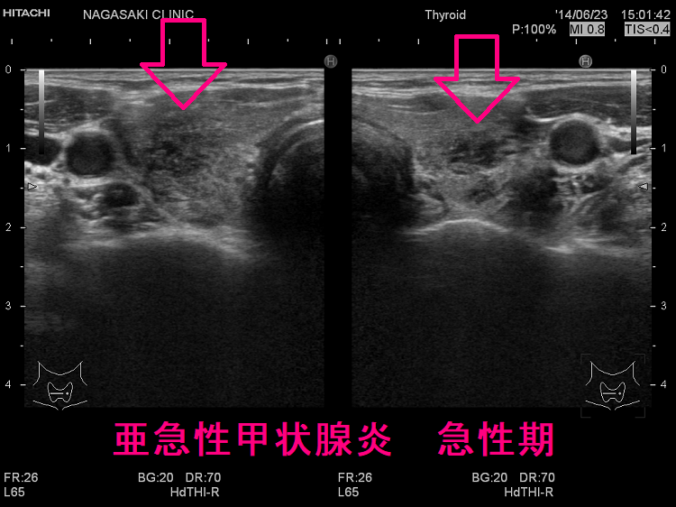 亜急性甲状腺炎 急性期 超音波(エコー)画像 亜急性甲状腺炎 急性期 超音波(エコー)画像