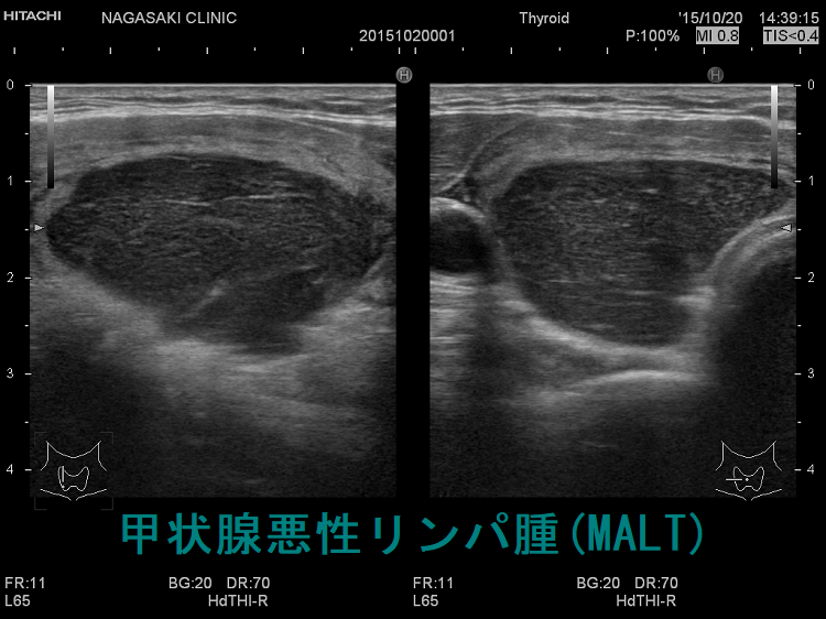 甲状腺原発悪性リンパ腫 超音波(エコー)画像:通常モード 甲状腺原発悪性リンパ腫 超音波(エコー)画像:通常モード