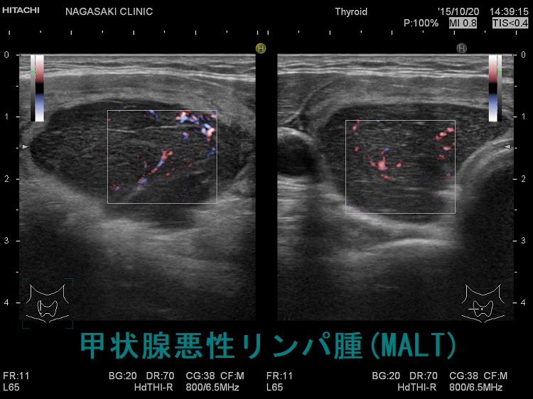 甲状腺原発悪性リンパ腫 超音波(エコー)画像:血流 甲状腺原発悪性リンパ腫 超音波(エコー)画像:血流