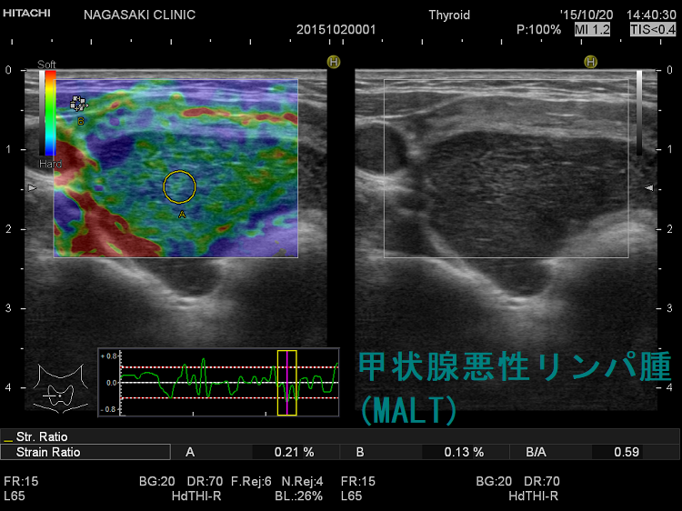 甲状腺原発悪性リンパ腫 超音波(エコー)画像:エラストグラフィー 甲状腺原発悪性リンパ腫(MALT)超音波(エコー)画像:エラストグラフィー