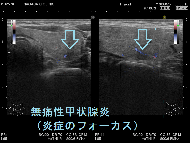 無痛性甲状腺炎(炎症のフォーカス) 無痛性甲状腺炎(炎症のフォーカス)