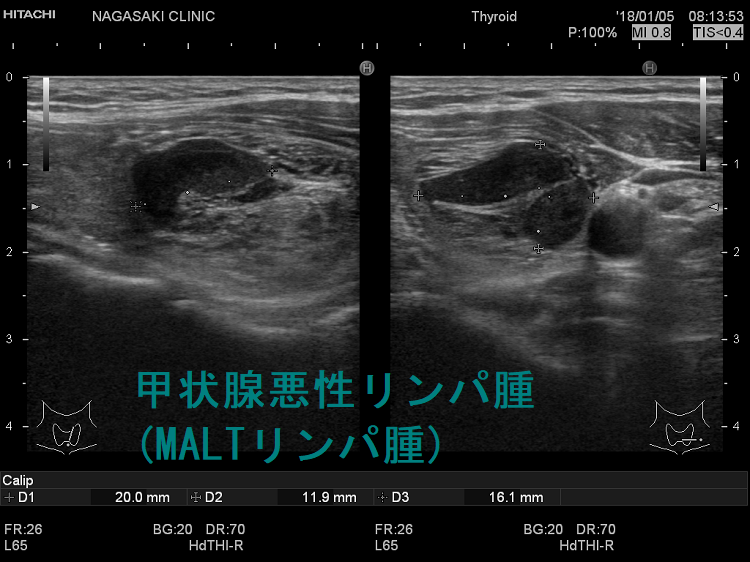 甲状腺悪性リンパ腫(MALTリンパ腫) 超音波(エコー)画像 甲状腺悪性リンパ腫(MALTリンパ腫) 超音波(エコー)画像
