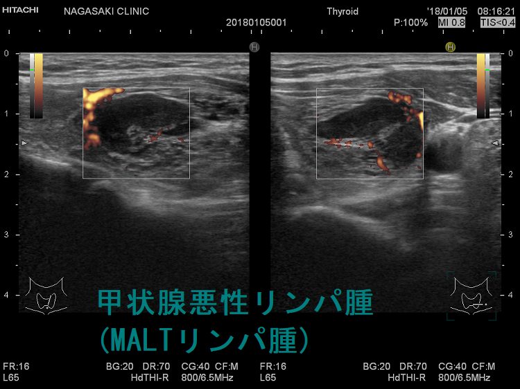 甲状腺悪性リンパ腫(MALTリンパ腫) 超音波(エコー)画像 ドプラーモード 甲状腺悪性リンパ腫(MALTリンパ腫) 超音波(エコー)画像 ドプラーモード