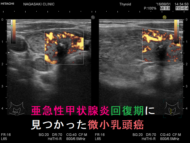 亜急性甲状腺炎回復期に微小乳頭癌 亜急性甲状腺炎回復期に微小乳頭癌