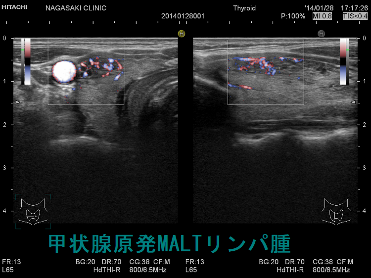 甲状腺原発MALTリンパ腫 超音波(エコー)画像 ドプラーモード 甲状腺原発MALTリンパ腫 超音波(エコー)画像 ドプラーモード