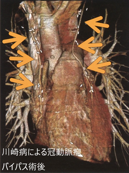 川崎病による冠動脈瘤 バイパス術後 川崎病による冠動脈瘤 バイパス術後