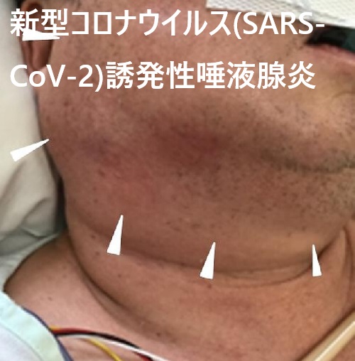 新型コロナウイルス(SARS-CoV-2)関連唾液腺炎 新型コロナウイルス(SARS-CoV-2)関連唾液腺炎