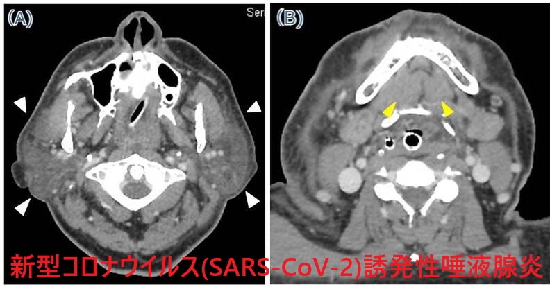 新型コロナウイルス(SARS-CoV-2)関連唾液腺炎 CT画像 新型コロナウイルス(SARS-CoV-2)関連唾液腺炎 CT画像