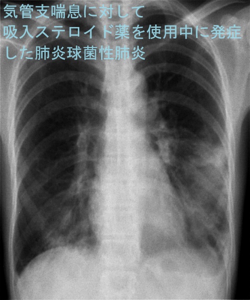 気管支喘息に対して吸入ステロイド薬を使用中に発症した肺炎球菌性肺炎 気管支喘息に対して吸入ステロイド薬を使用中に発症した肺炎球菌性肺炎