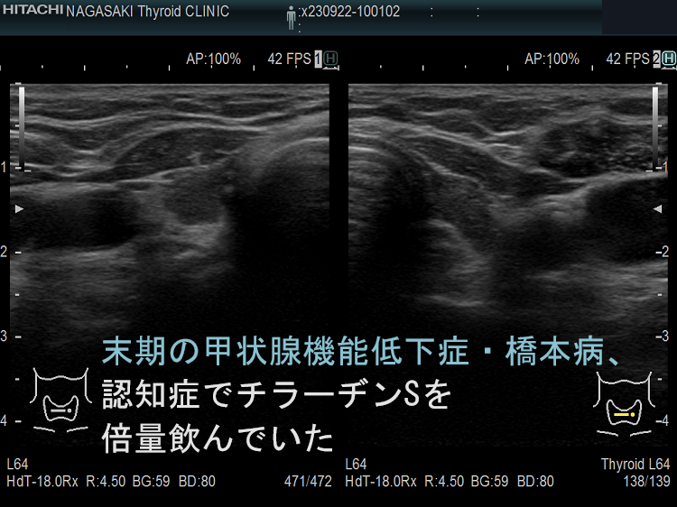 末期の甲状腺機能低下症・橋本病、認知症でチラーヂン倍量飲んでいた 末期の甲状腺機能低下症・橋本病、認知症でチラーヂン倍量飲んでいた