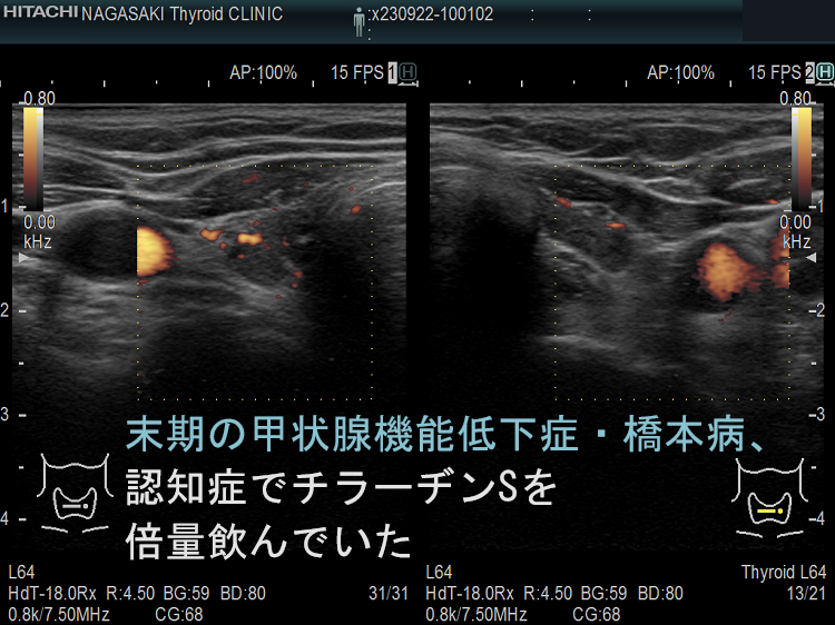 末期の甲状腺機能低下症・橋本病、認知症でチラーヂン倍量飲んでいた ドプラーモード 末期の甲状腺機能低下症・橋本病、認知症でチラーヂン倍量飲んでいた ドプラーモード
