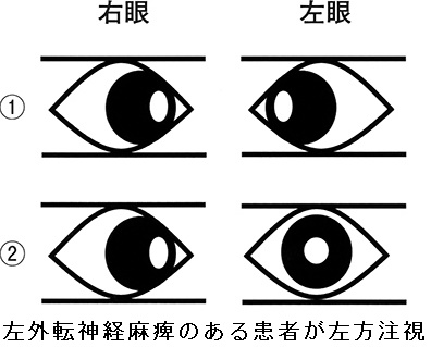 左外転神経麻痺のある患者が左方注視 左外転神経麻痺のある患者が左方注視