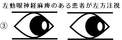 左動眼神経麻痺のある患者が左方注視 左動眼神経麻痺のある患者が左方注視
