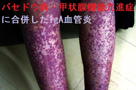 バセドウ病・甲状腺機能亢進症に合併したIgA血管炎(ヘノッホシェーンライン紫斑病) バセドウ病・甲状腺機能亢進症に合併したIgA血管炎(ヘノッホシェーンライン紫斑病)