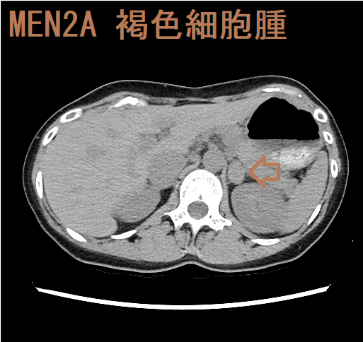 MEN2A 褐色細胞腫 単純CT画像 MEN2A 褐色細胞腫 単純CT画像
