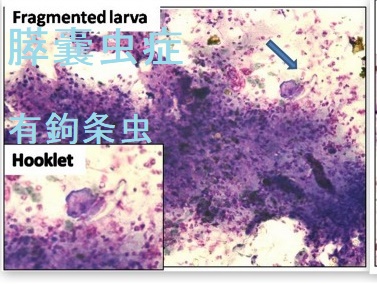 膵嚢虫症 膵嚢虫症