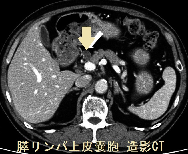 超希少石】膵結石超希少な膵結石膵石スイセキ人体石標本資料