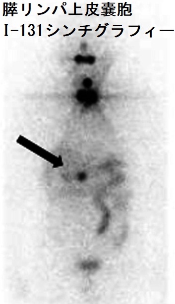 膵リンパ上皮嚢胞 放射性ヨウ素(I-131)全身シンチグラフィー 膵リンパ上皮嚢胞 放射性ヨウ素(I-131)全身シンチグラフィー