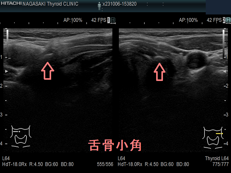 舌骨小角 舌骨小角